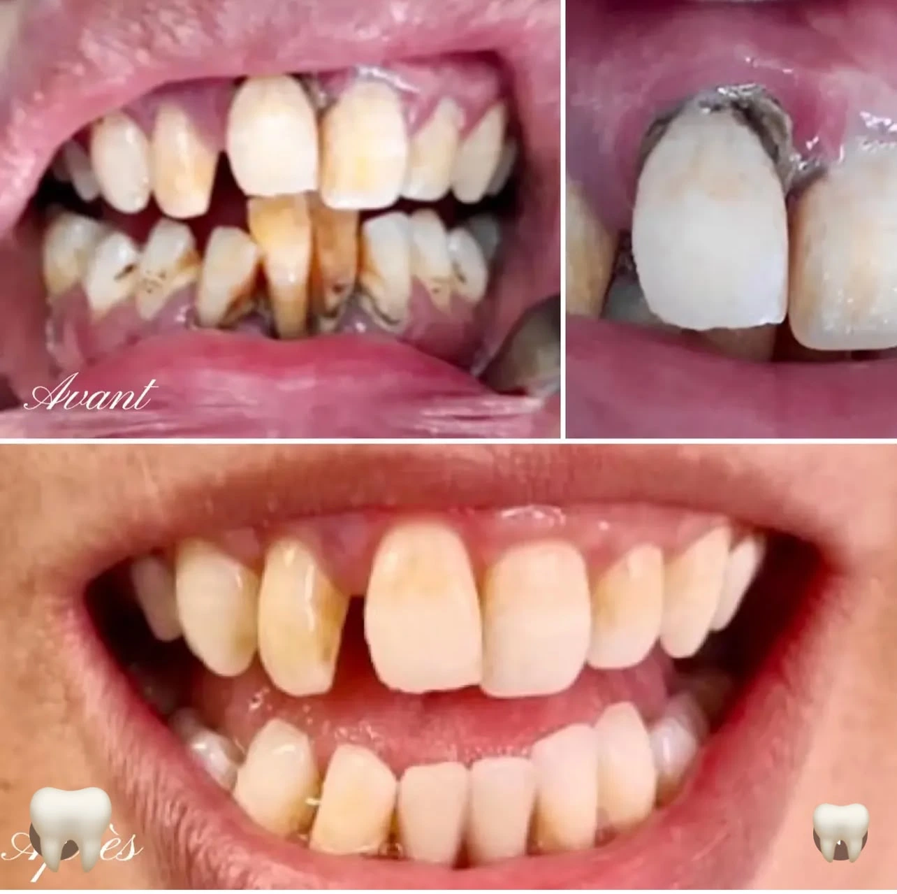 Détartrage professionnel Dr Ibnou Zahir Casablanca